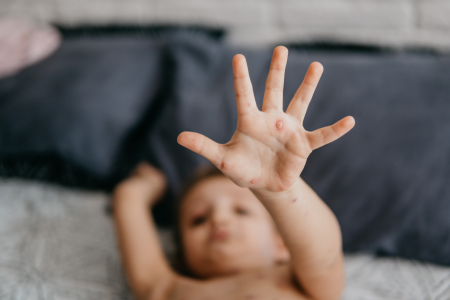 Sarampo cresce 32 vezes nas Américas em um ano; veja situação do Brasil